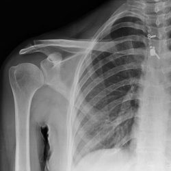 Dislocation of the clavicle initial encounter
